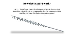 how does essure work