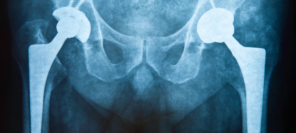 Xray showing two metal hip implants after hip replacement surgery in Toronto, Canada.