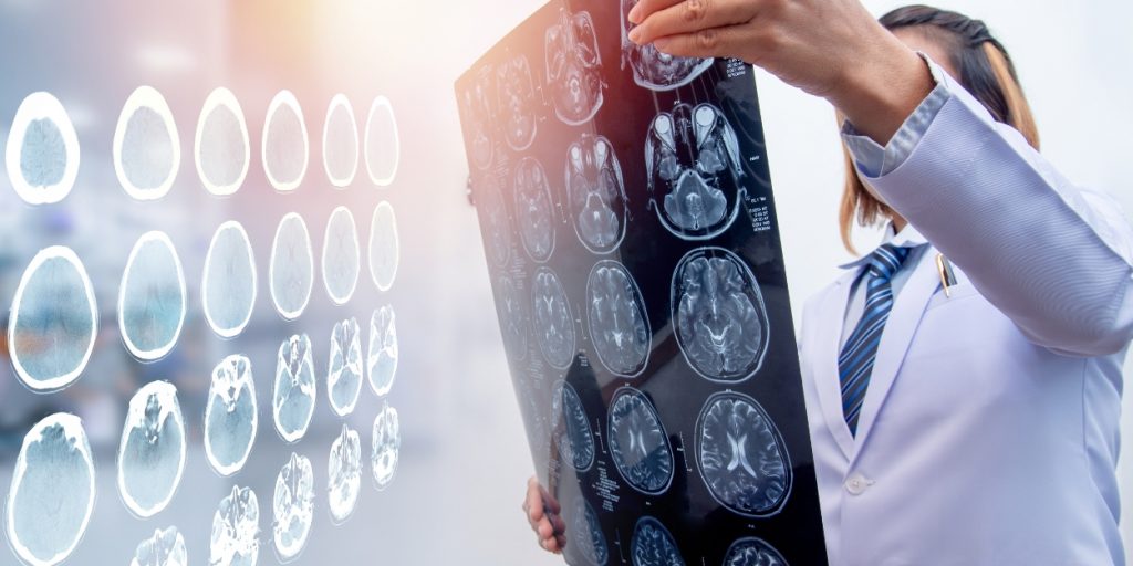 A doctor reviewing head x-rays of a traumatic brain injury caused by a car accident in Toronto, Canada.